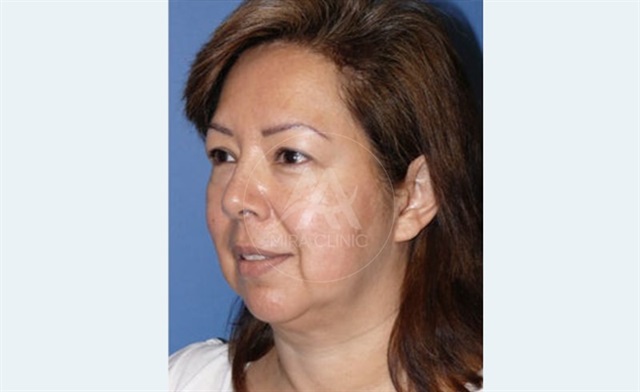 Nefertiti Lift in Turkey 2025: Methods, Recovery, and Costs